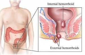 hemroids bleeding