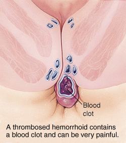treatment of thrombosed hemorrhoids