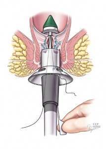 Hemorrhoid Treatment Image