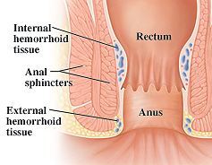 Hemorrhoidal Tissue Image