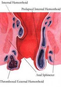 Internal Hemorrhoids Image