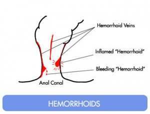 Bleeding Hemorrhoid Diagram Image