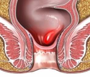 Bleeding Hemorrhoid Image