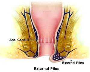 External Hemorrhoids Image