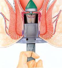 Hemorrhoid Surgery Procedure Image