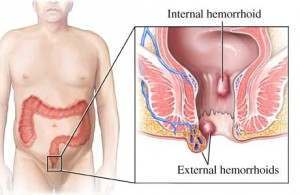 Hemorrhoids Internal External Anatomy Image