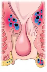 Internal Hemorrhoids Image