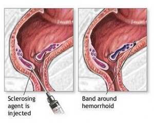 Rubber Bands Hemorrhoids Image